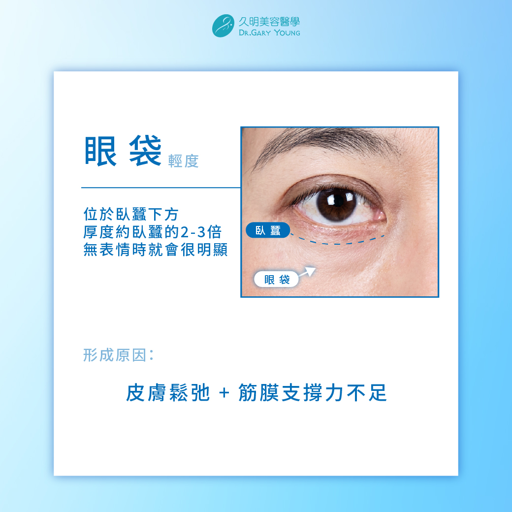 👀眼袋不是胖，是「撐不住」了