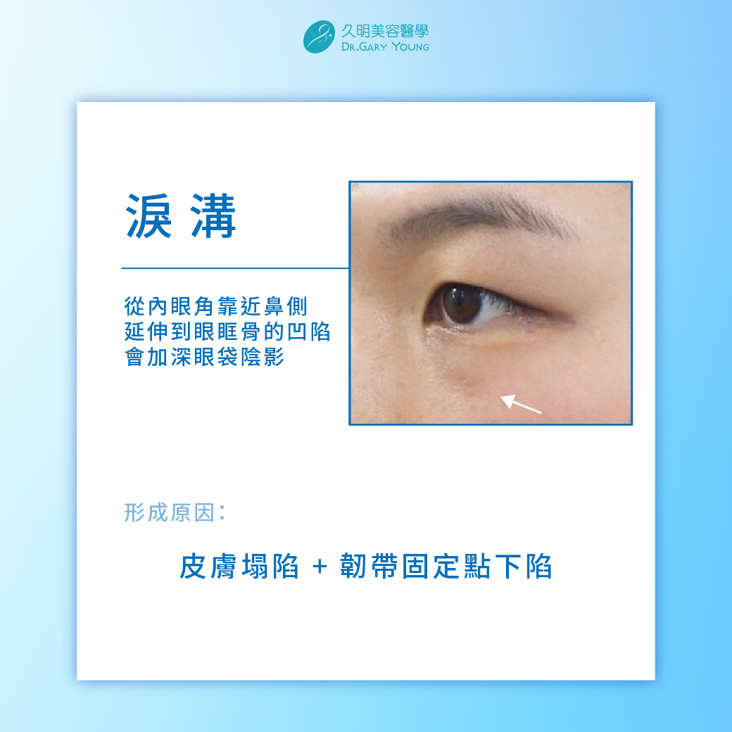 👀淚溝是地形問題，不是哭太多