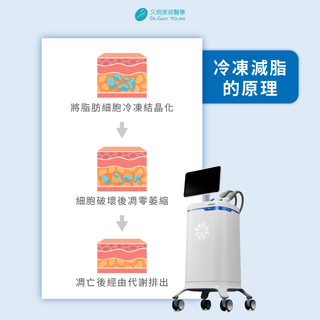 🙋🏻‍♀️🙋🏻‍♂️醫生醫生，做冷凍減脂會痛嗎？