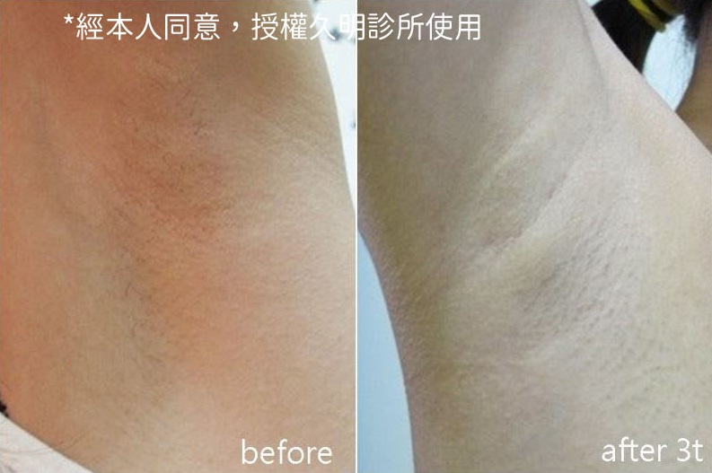 專業彩衝除毛雷射