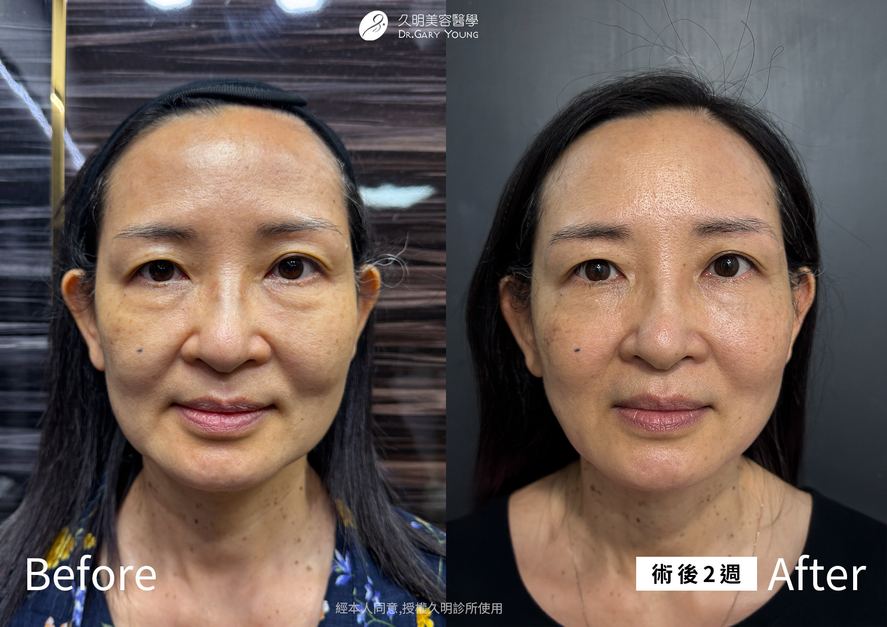 逆時針 PROFHILO 可以改善的部位與效果？