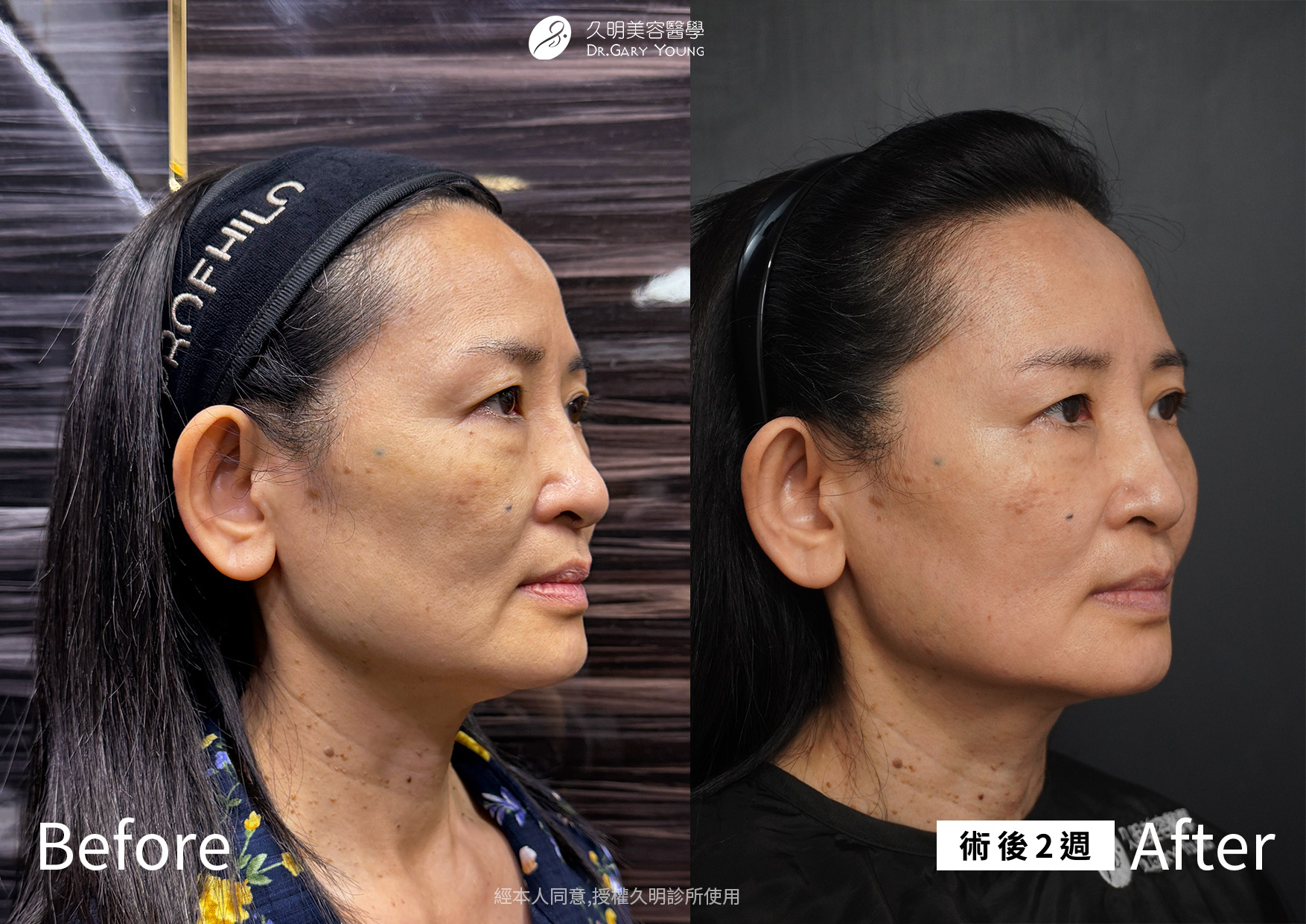 逆時針 PROFHILO 需要打幾次？效果維持多久?
